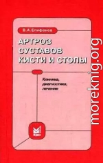 Артроз суставов кисти и стопы: клиника, диагностика, лечение