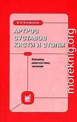 Артроз суставов кисти и стопы: клиника, диагностика, лечение